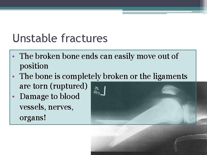 Unstable fractures • The broken bone ends can easily move out of position •