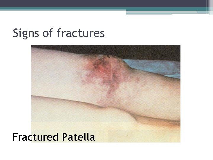 Signs of fractures Fractured Patella 