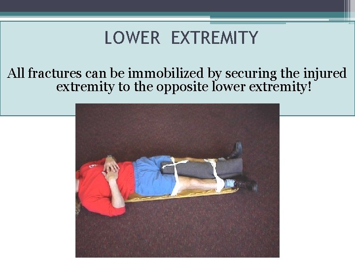 LOWER EXTREMITY All fractures can be immobilized by securing the injured extremity to the