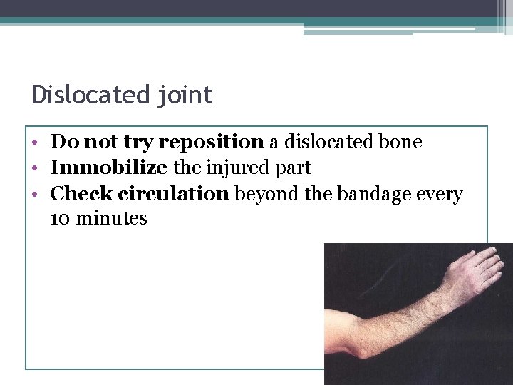 Dislocated joint • Do not try reposition a dislocated bone • Immobilize the injured