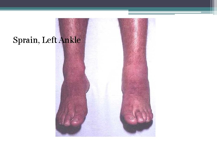 Sprain, Left Ankle 