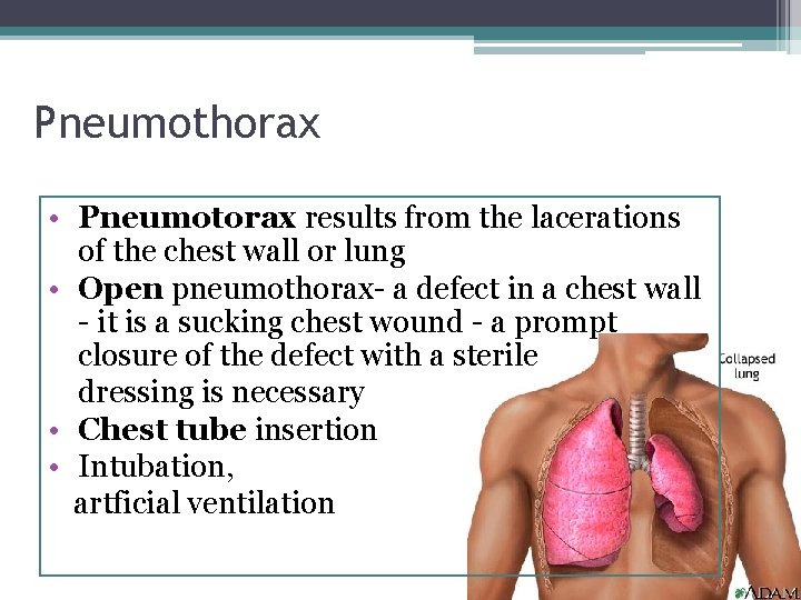 Pneumothorax • Pneumotorax results from the lacerations of the chest wall or lung •