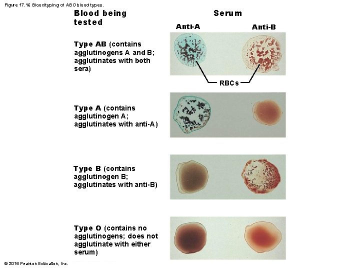 Figure 17. 16 Blood typing of ABO blood types. Blood being tested Serum Anti-A