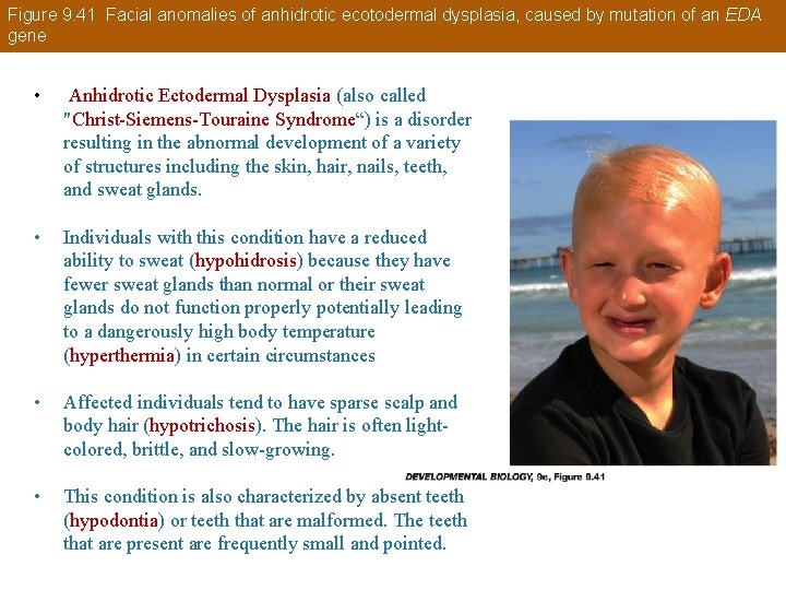 Figure 9. 41 Facial anomalies of anhidrotic ecotodermal dysplasia, caused by mutation of an