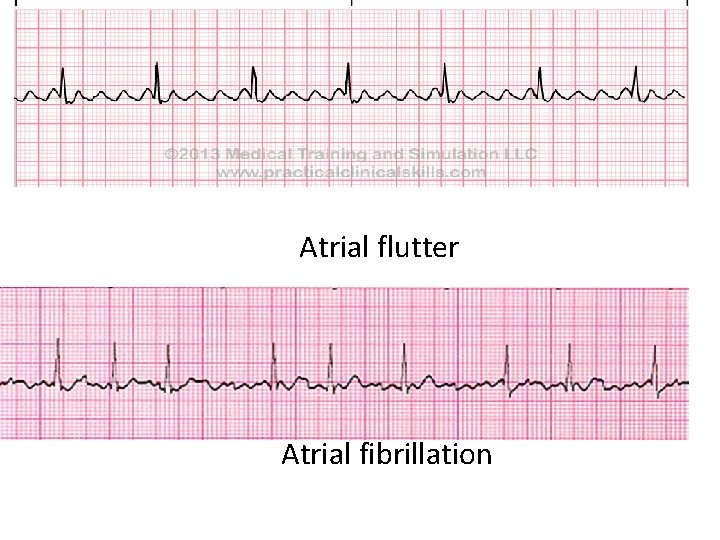 Atrial flutter Atrial fibrillation 