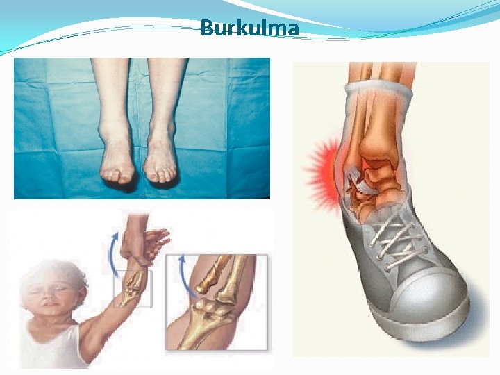 Burkulma Burkulma