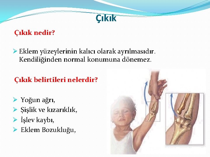 Çıkık nedir? Ø Eklem yüzeylerinin kalıcı olarak ayrılmasıdır. Kendiliğinden normal konumuna dönemez. Çıkık belirtileri