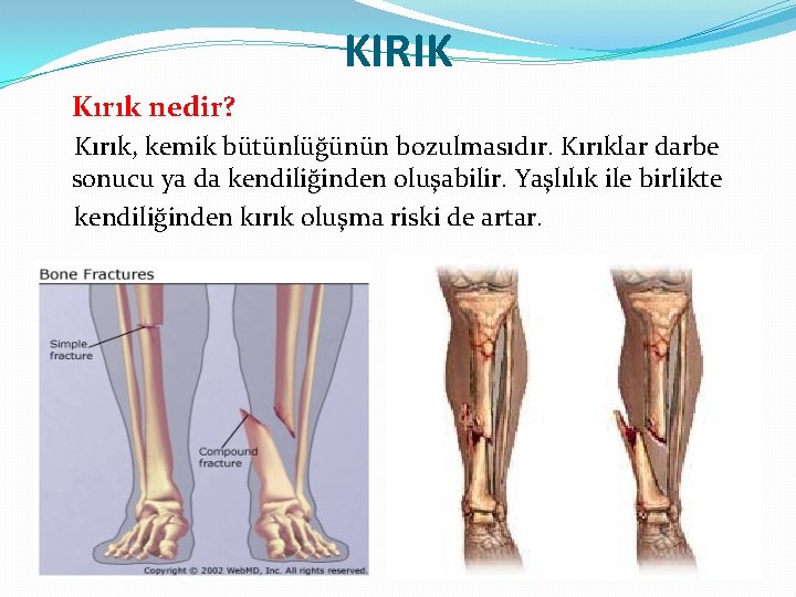 KIRIK Kırık nedir? Kırık, kemik bütünlüğünün bozulmasıdır. Kırıklar darbe sonucu ya da kendiliğinden oluşabilir.