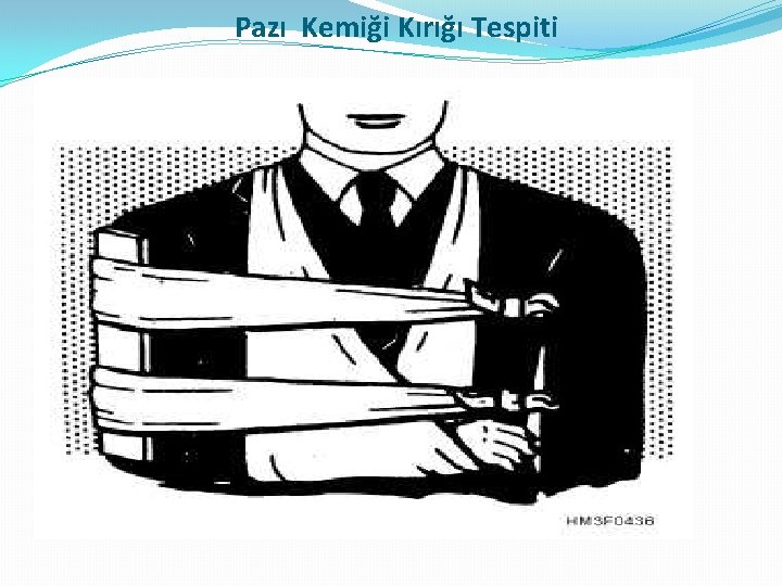 Pazı Kemiği Kırığı Tespiti Pazı Kemiği Kırığı Tespiti