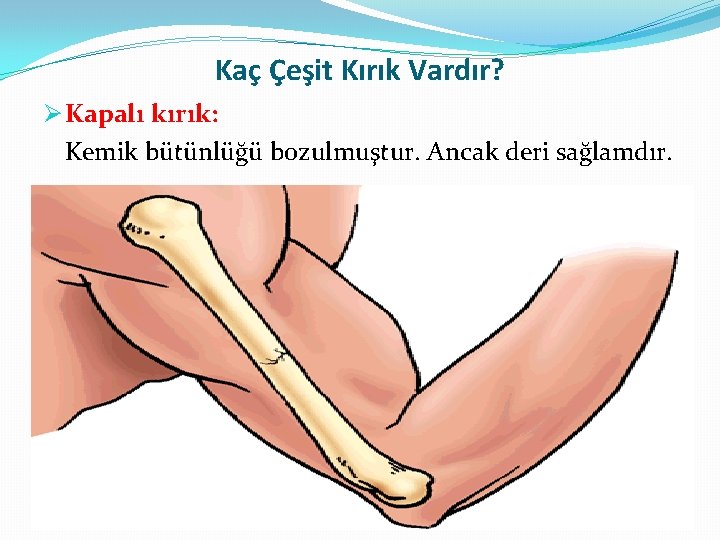 Kaç Çeşit Kırık Vardır? Ø Kapalı kırık: Kemik bütünlüğü bozulmuştur. Ancak deri sağlamdır. 