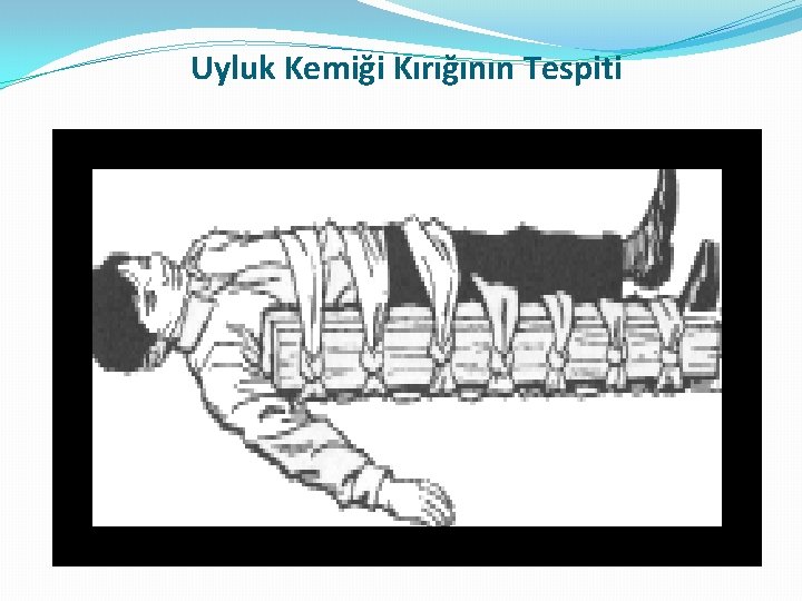 Uyluk Kemiği Kırığının Tespiti 