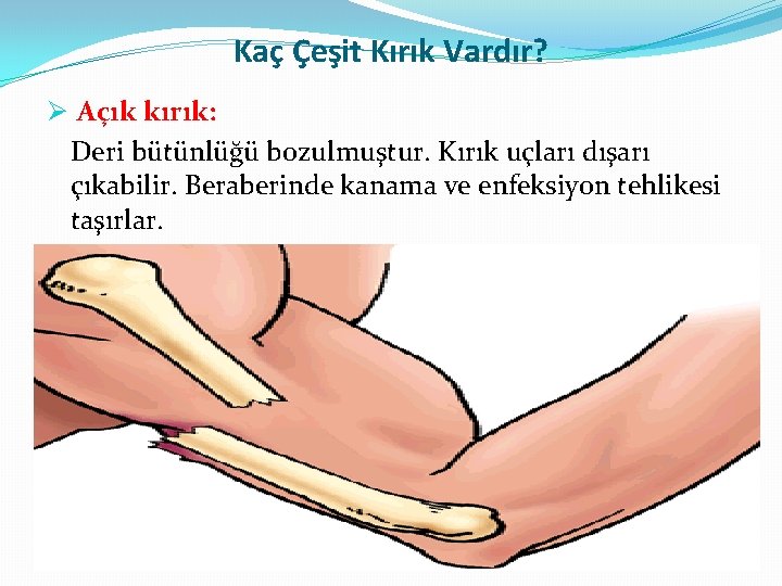 Kaç Çeşit Kırık Vardır? Ø Açık kırık: Deri bütünlüğü bozulmuştur. Kırık uçları dışarı çıkabilir. Kaç Çeşit Kırık Vardır? Ø Açık kırık: Deri bütünlüğü bozulmuştur. Kırık uçları dışarı çıkabilir.