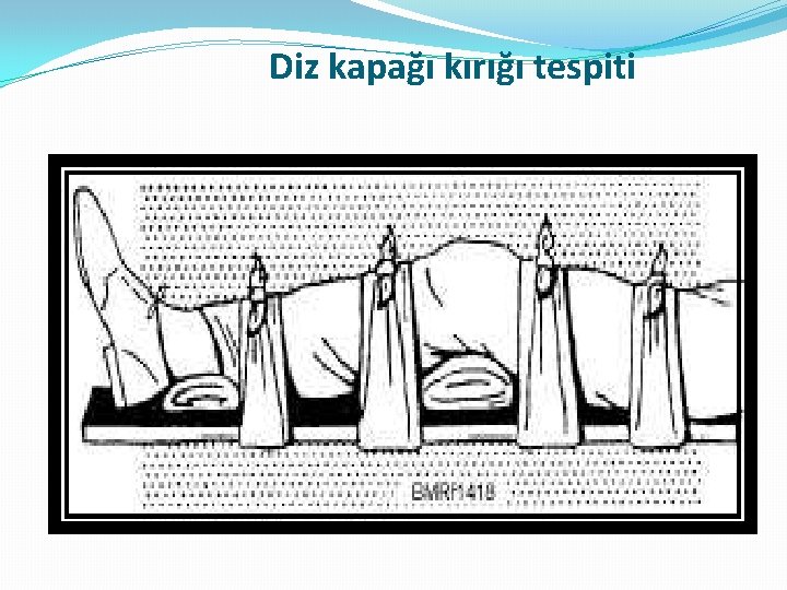 Diz kapağı kırığı tespiti Diz kapağı kırığı tespiti