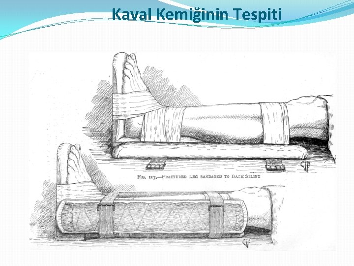 Kaval Kemiğinin Tespiti Kaval Kemiğinin Tespiti