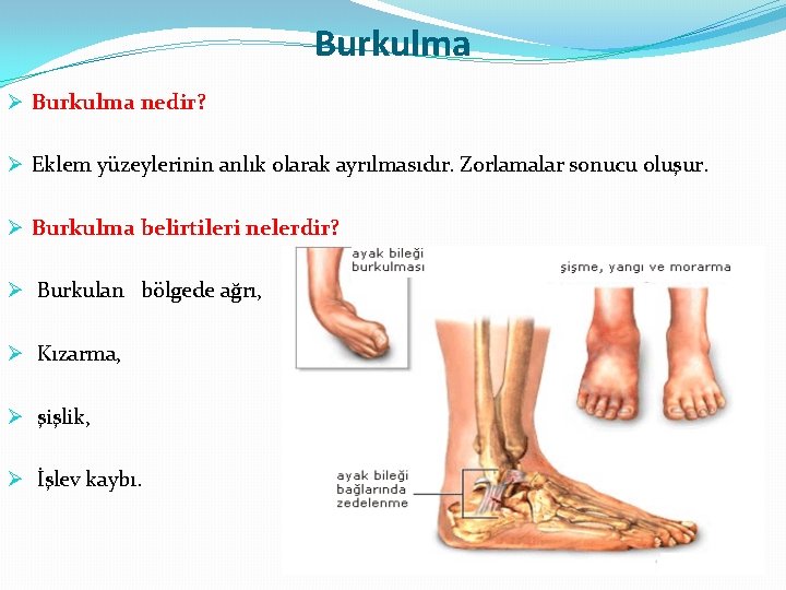 Burkulma Ø Burkulma nedir? Ø Eklem yüzeylerinin anlık olarak ayrılmasıdır. Zorlamalar sonucu oluşur. Ø Burkulma Ø Burkulma nedir? Ø Eklem yüzeylerinin anlık olarak ayrılmasıdır. Zorlamalar sonucu oluşur. Ø