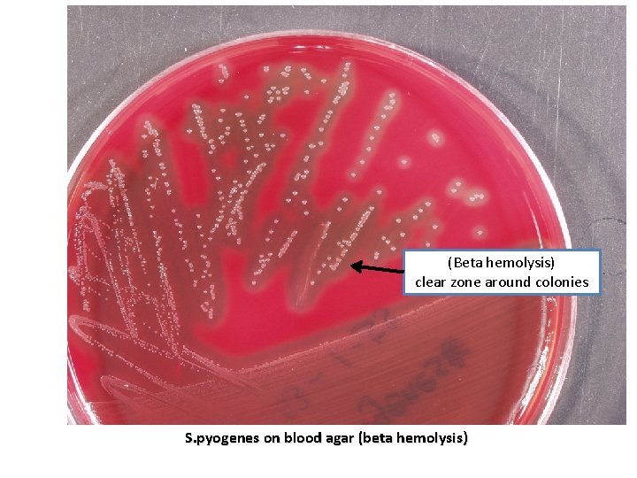 (Beta hemolysis) clear zone around colonies S. pyogenes on blood agar (beta hemolysis) (Beta hemolysis) clear zone around colonies S. pyogenes on blood agar (beta hemolysis)