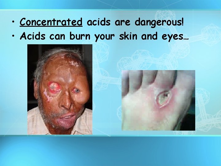  • Concentrated acids are dangerous! • Acids can burn your skin and eyes…