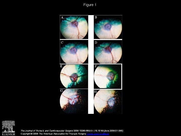 Figure 1 The Journal of Thoracic and Cardiovascular Surgery 2006 13280 -88 DOI: (10.