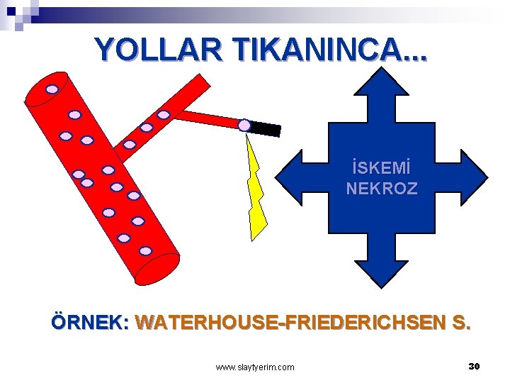 YOLLAR TIKANINCA. . . İSKEMİ NEKROZ ÖRNEK: WATERHOUSE-FRIEDERICHSEN S. www. slaytyerim. com 30 