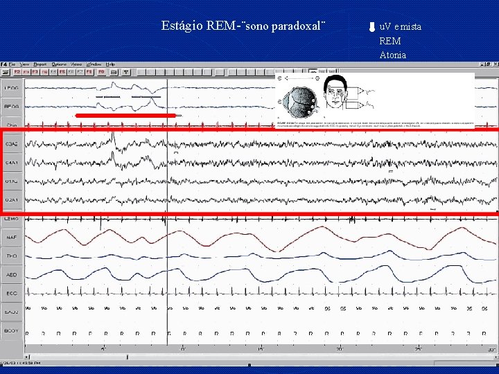 Estágio REM-¨sono paradoxal¨ u. V e mista REM Atonia 