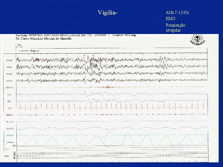 Vigilia- Alfa 7 -13 Hz EMG Respiração irregular 