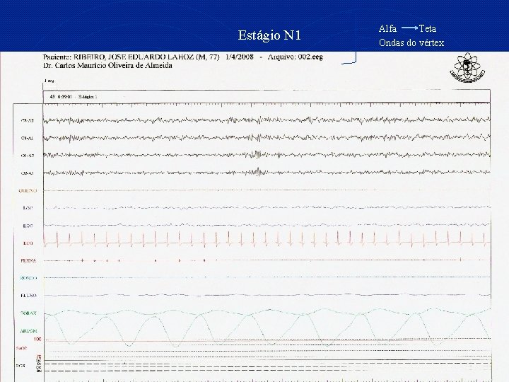 Estágio N 1 Alfa Teta Ondas do vértex 