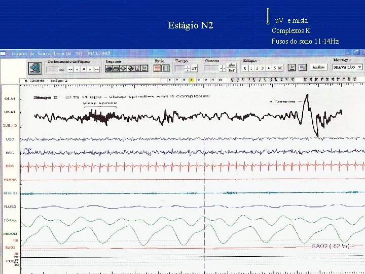 Estágio N 2 u. V e mista Complexos K Fusos do sono 11 -14