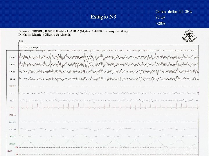 Estágio N 3 Ondas deltas 0, 5 -2 Hz 75 u. V >20% 