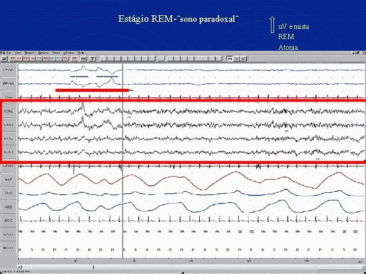 Estágio REM-¨sono paradoxal¨ u. V e mista REM Atonia 