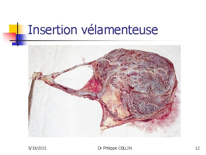 Insertion vélamenteuse 5/19/2021 Dr Philippe COLLIN 12 