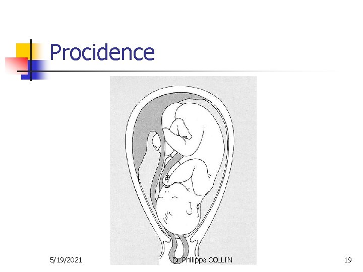 Procidence 5/19/2021 Dr Philippe COLLIN 19 