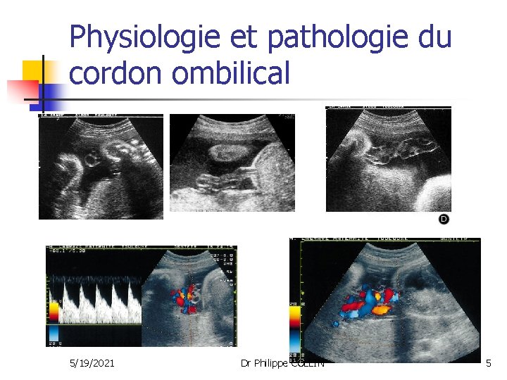 Physiologie et pathologie du cordon ombilical 5/19/2021 Dr Philippe COLLIN 5 