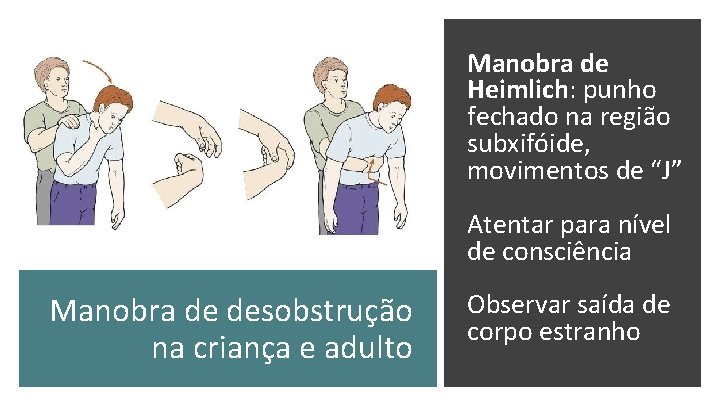 Manobra de Heimlich: punho fechado na região subxifóide, movimentos de “J” Atentar para nível