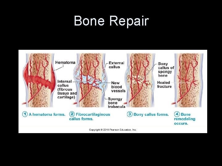 Bone Repair 