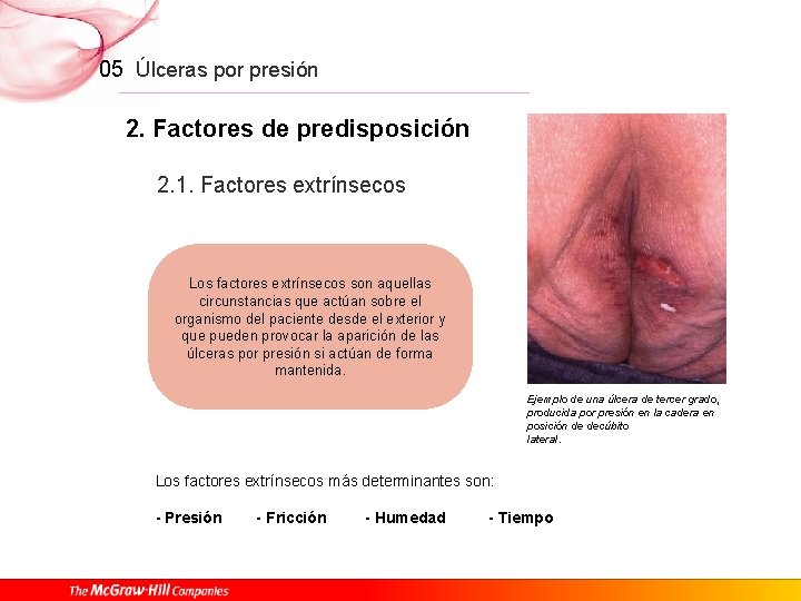 05 Úlceras por presión 2. Factores de predisposición 2. 1. Factores extrínsecos Los factores