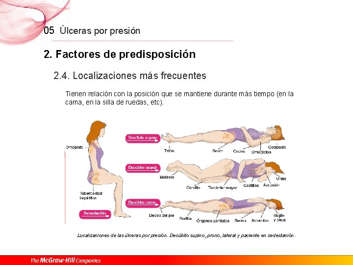 05 Úlceras por presión 2. Factores de predisposición 2. 4. Localizaciones más frecuentes Tienen