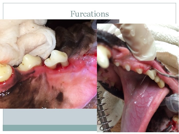 Furcations 
