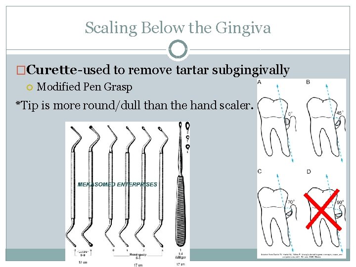 Scaling Below the Gingiva �Curette-used to remove tartar subgingivally Modified Pen Grasp *Tip is