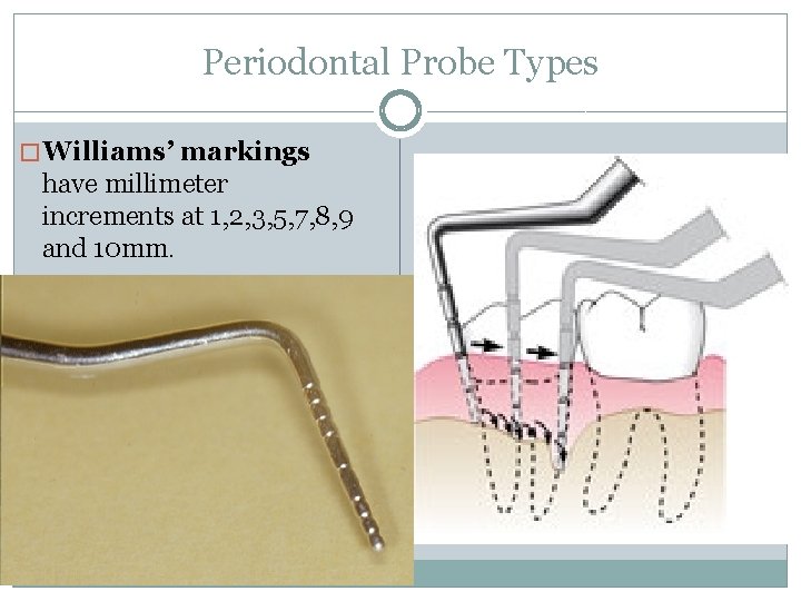 Periodontal Probe Types � Williams’ markings have millimeter increments at 1, 2, 3, 5,