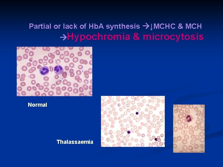 Partial or lack of Hb. A synthesis ↓MCHC & MCH Hypochromia Normal Thalassaemia &