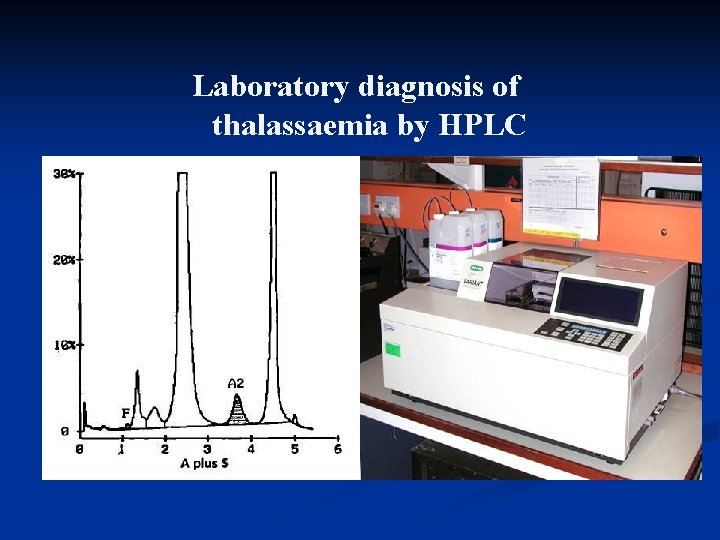 Laboratory diagnosis of thalassaemia by HPLC 