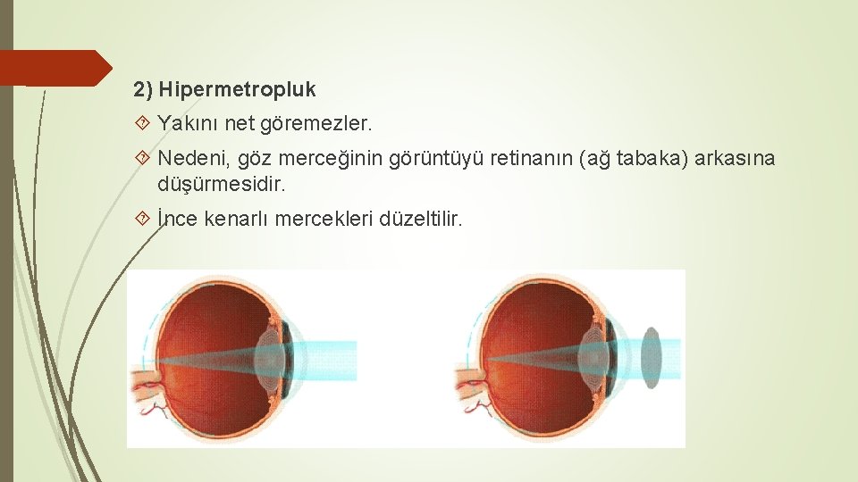 2) Hipermetropluk Yakını net göremezler. Nedeni, göz merceğinin görüntüyü retinanın (ağ tabaka) arkasına düşürmesidir.