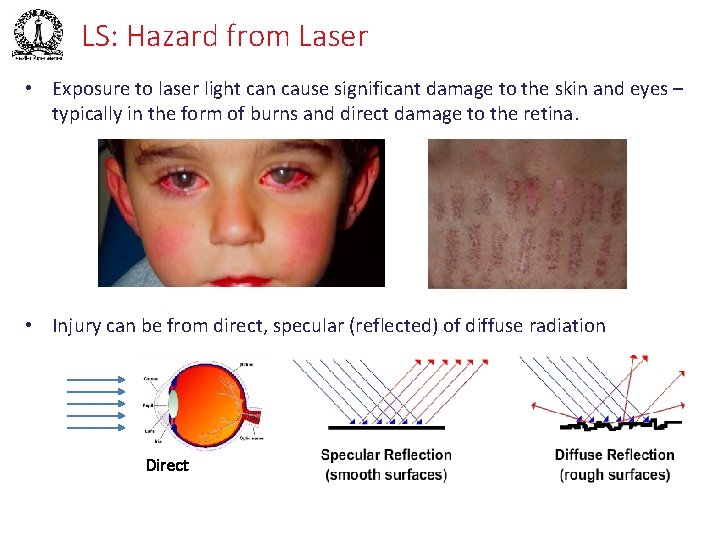 LS: Hazard from Laser • Exposure to laser light can cause significant damage to