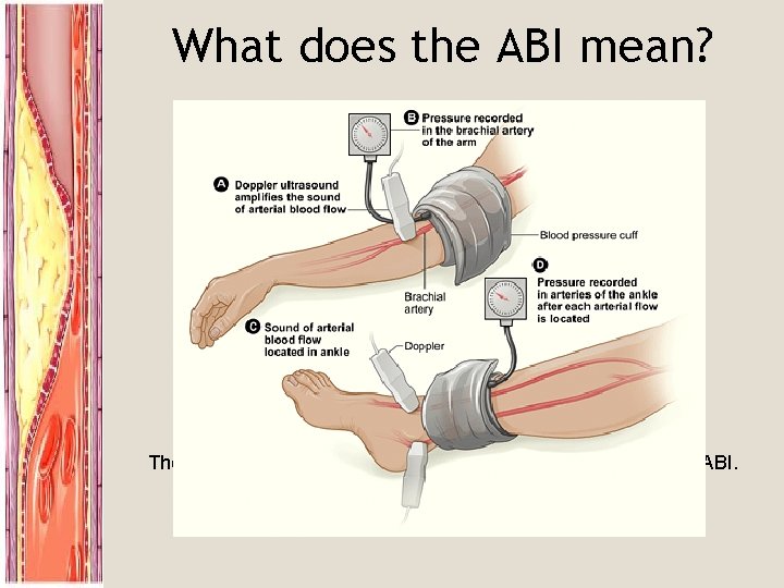What does the ABI mean? ABI Clinical Correlation >0. 9 Normal Limb 0. 5
