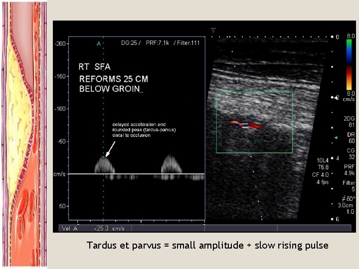 Tardus et parvus = small amplitude + slow rising pulse 