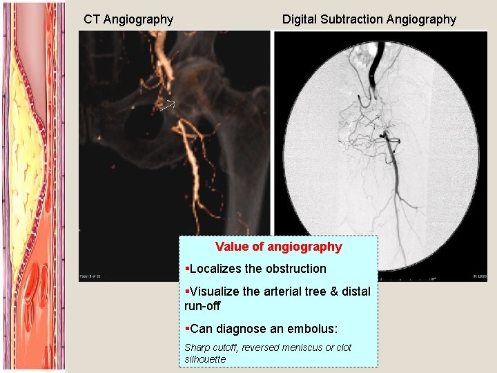 CT Angiography Digital Subtraction Angiography Value of angiography §Localizes the obstruction §Visualize the arterial