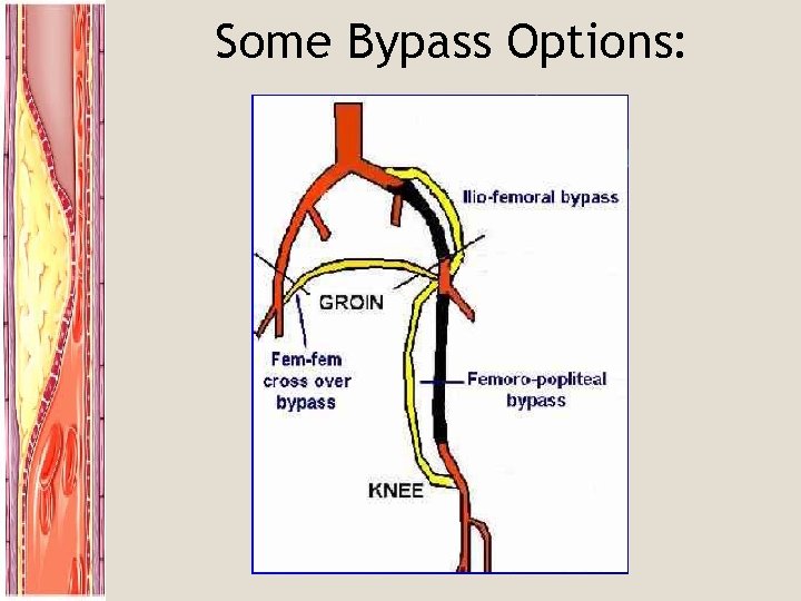 Some Bypass Options: 