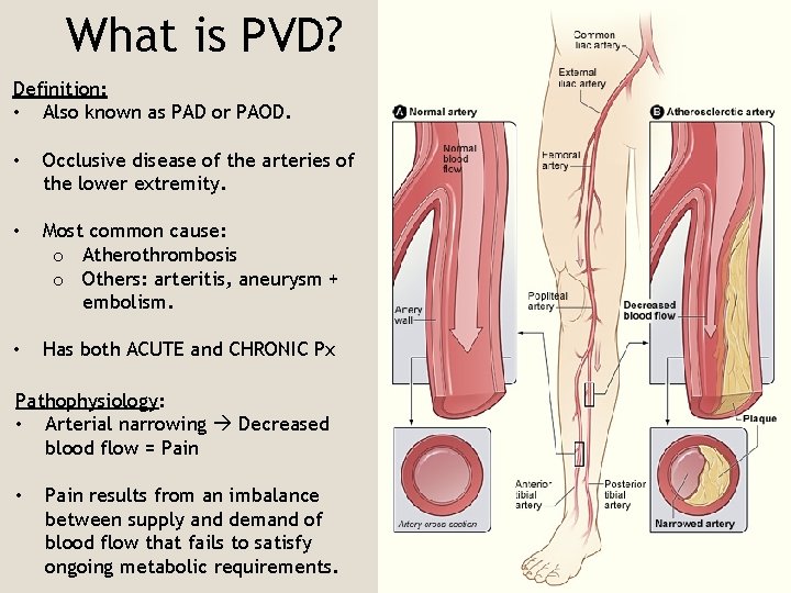 What is PVD? Definition: • Also known as PAD or PAOD. • Occlusive disease