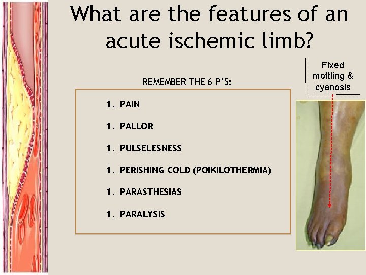 What are the features of an acute ischemic limb? REMEMBER THE 6 P’S: 1.
