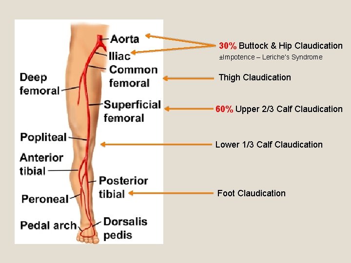 30% Buttock & Hip Claudication ±Impotence – Leriche’s Syndrome Thigh Claudication 60% Upper 2/3